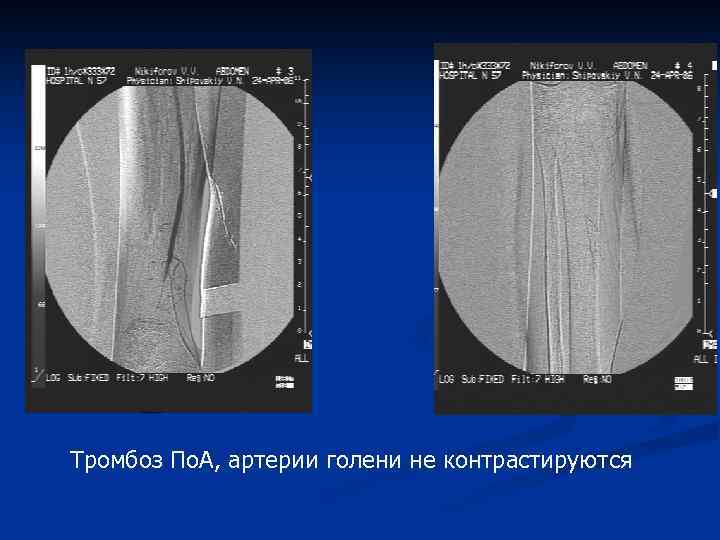 Тромбоз По. А, артерии голени не контрастируются 