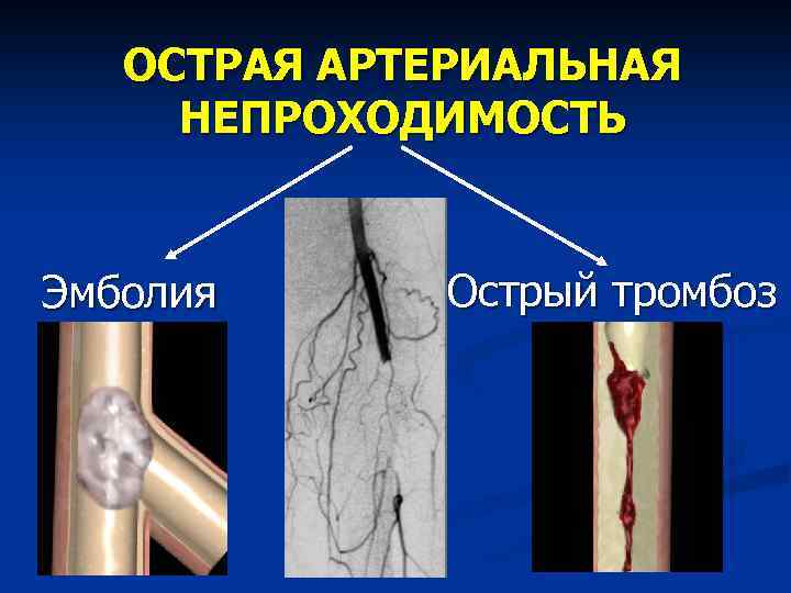 Острая артериальная непроходимость нижних конечностей презентация