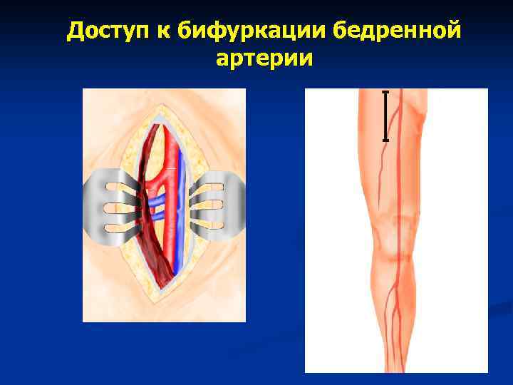 Доступ к бифуркации бедренной артерии 