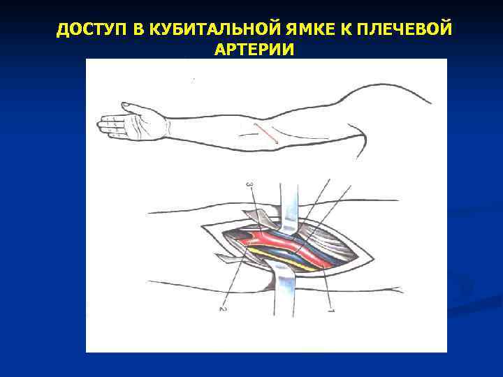 ДОСТУП В КУБИТАЛЬНОЙ ЯМКЕ К ПЛЕЧЕВОЙ АРТЕРИИ 