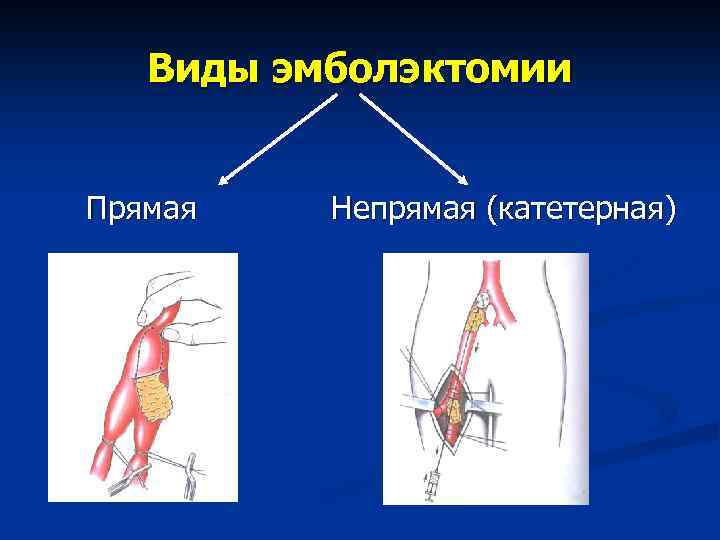 Синдром мезентериальной ишемии презентация