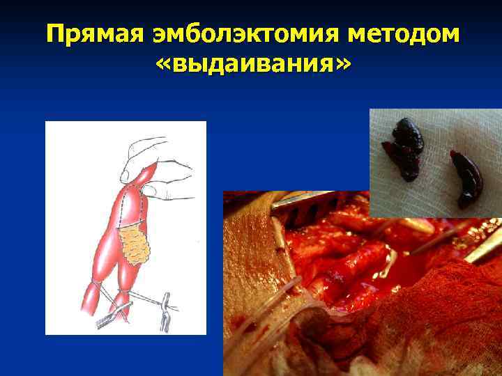 Прямая эмболэктомия методом «выдаивания» 