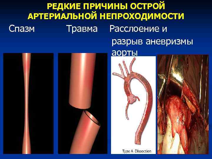 Острая артериальная непроходимость нижних конечностей презентация