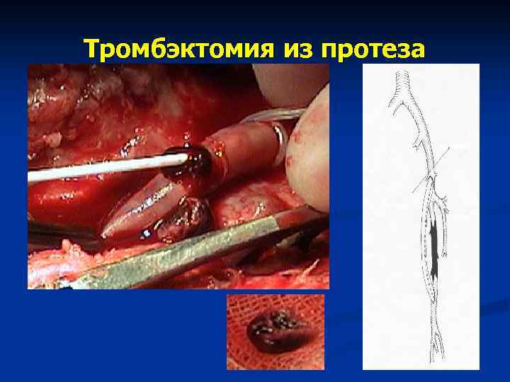 Тромбэктомия из протеза 