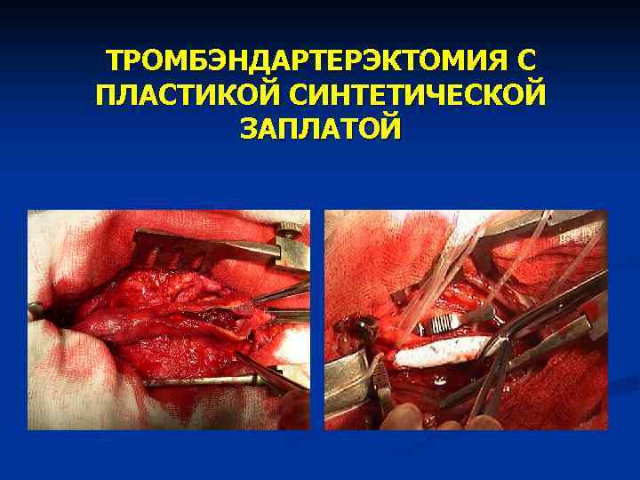 ТРОМБЭНДАРТЕРЭКТОМИЯ С ПЛАСТИКОЙ СИНТЕТИЧЕСКОЙ ЗАПЛАТОЙ 