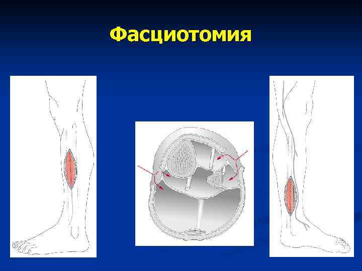 Острая артериальная ишемия презентация