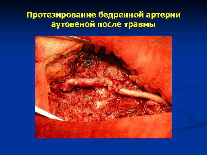 Протезирование бедренной артерии аутовеной после травмы 