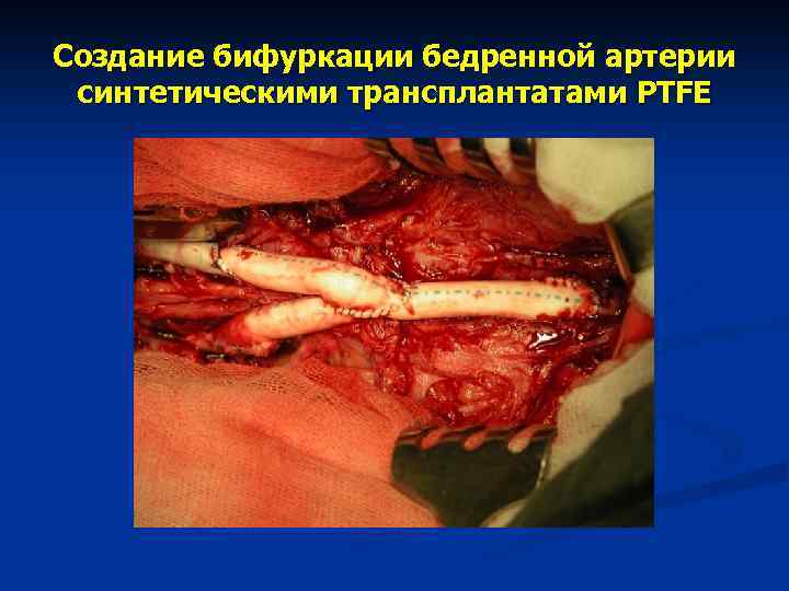 Создание бифуркации бедренной артерии синтетическими трансплантатами PTFE 