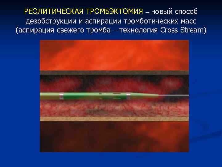 РЕОЛИТИЧЕСКАЯ ТРОМБЭКТОМИЯ – новый способ дезобструкции и аспирации тромботических масс (аспирация свежего тромба –