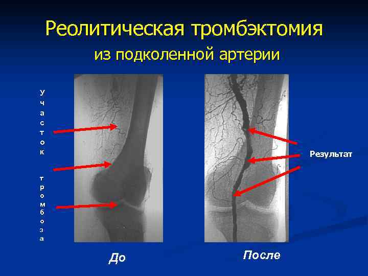 Реолитическая тромбэктомия из подколенной артерии У ч а с т о к Результат т