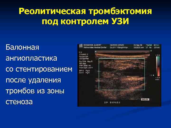 Реолитическая тромбэктомия под контролем УЗИ Балонная ангиопластика со стентированием после удаления тромбов из зоны