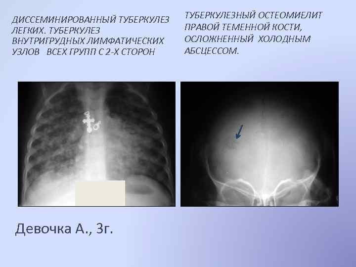 ДИССЕМИНИРОВАННЫЙ ТУБЕРКУЛЕЗ ЛЕГКИХ. ТУБЕРКУЛЕЗ ВНУТРИГРУДНЫХ ЛИМФАТИЧЕСКИХ УЗЛОВ ВСЕХ ГРУПП С 2 -Х СТОРОН Девочка