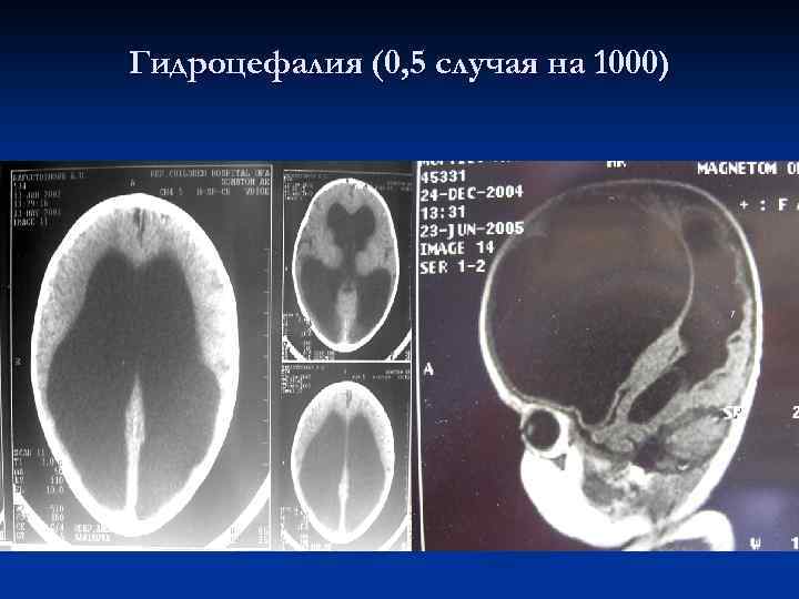 Гидроцефалия (0, 5 случая на 1000) 