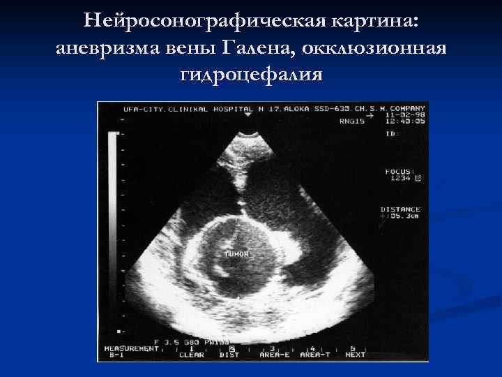Нейросонографическая картина: аневризма вены Галена, окклюзионная гидроцефалия 