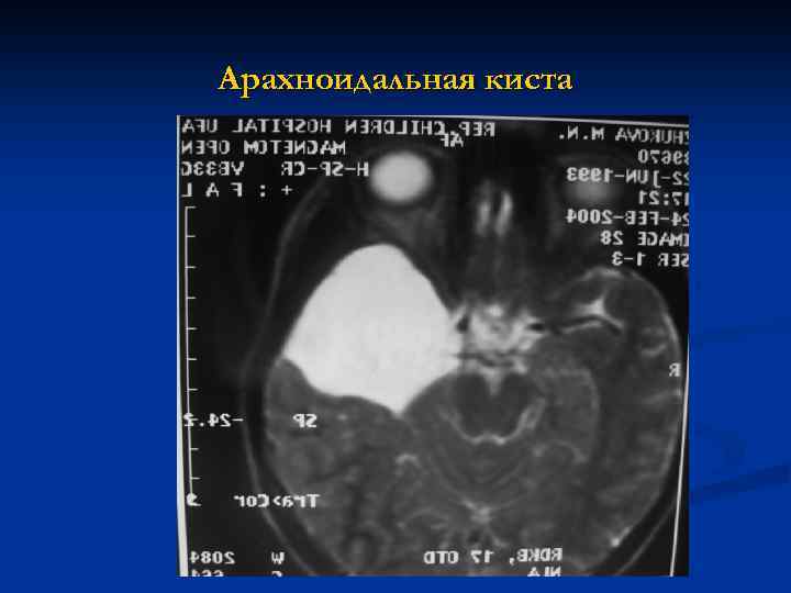 Арахноидальная киста 