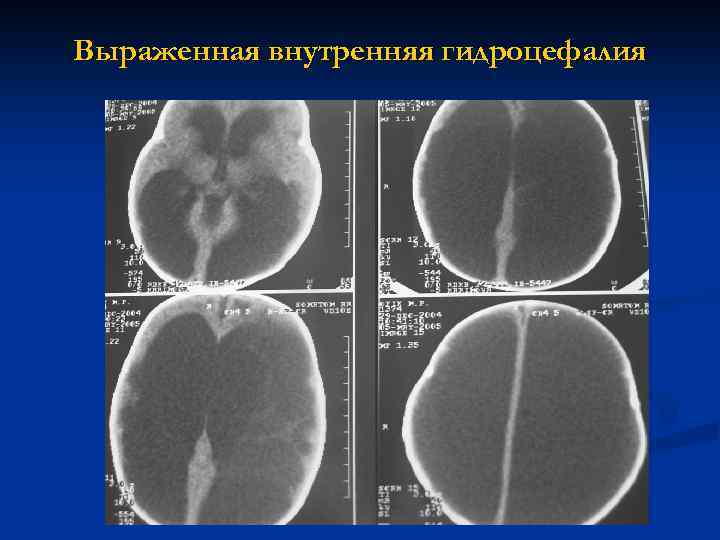 Выраженная внутренняя гидроцефалия 