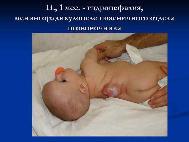 Н. , 1 мес. - гидроцефалия, менингорадикулоцеле поясничного отдела позвоночника 