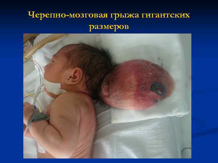 Черепно-мозговая грыжа гигантских размеров 