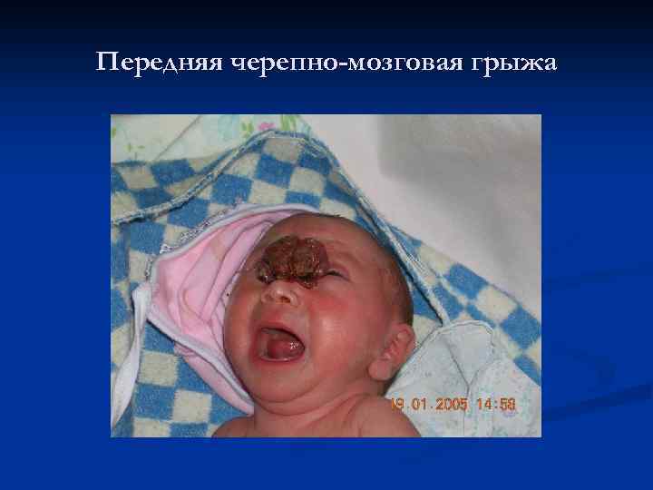 Передняя черепно-мозговая грыжа 