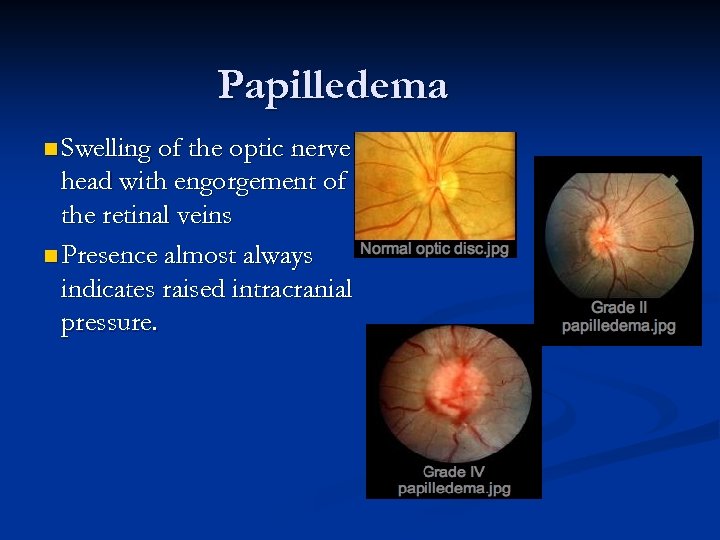 Papilledema n Swelling of the optic nerve head with engorgement of the retinal veins