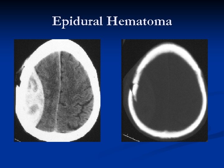 Epidural Hematoma 