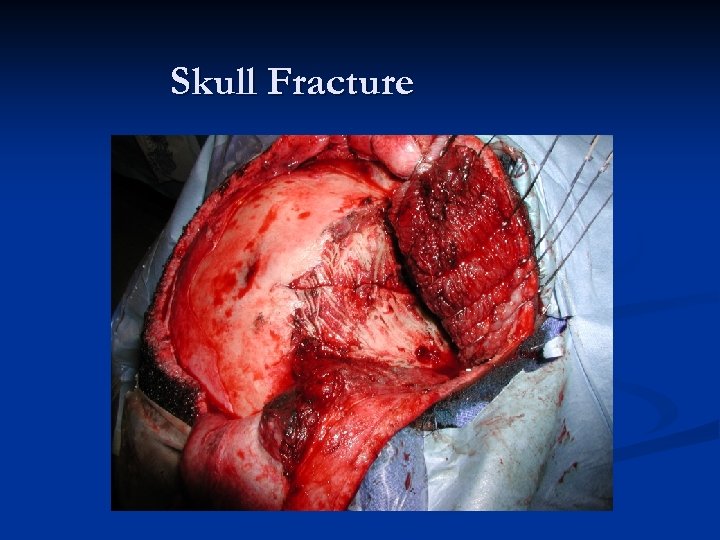 Skull Fracture 