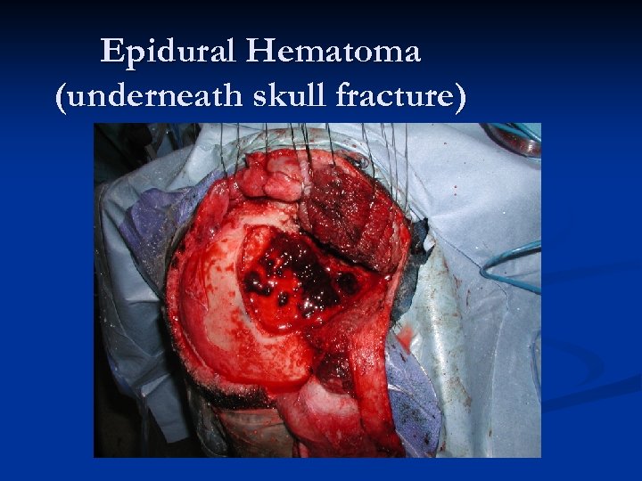 Epidural Hematoma (underneath skull fracture) 