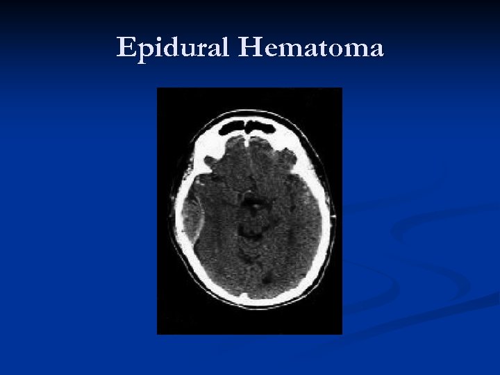 Epidural Hematoma 