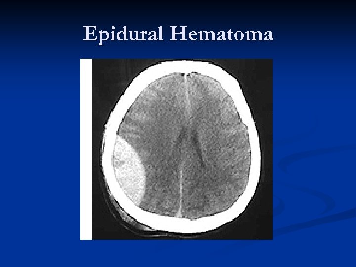 Epidural Hematoma 