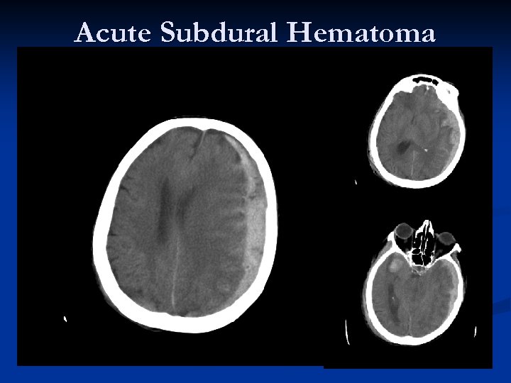 Acute Subdural Hematoma 