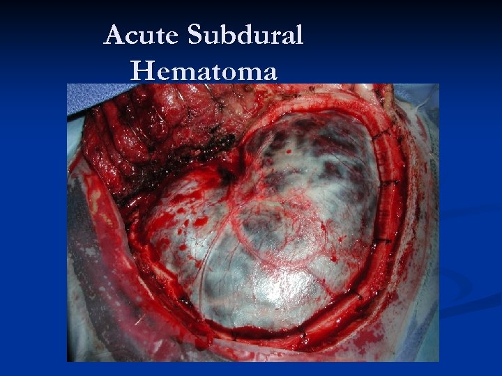 Acute Subdural Hematoma 