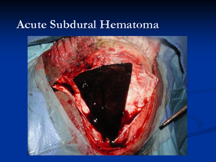 Acute Subdural Hematoma 