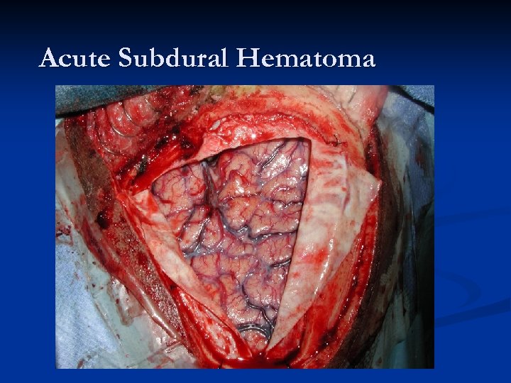 Acute Subdural Hematoma 