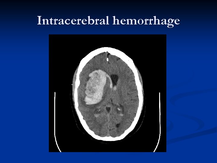 Intracerebral hemorrhage 