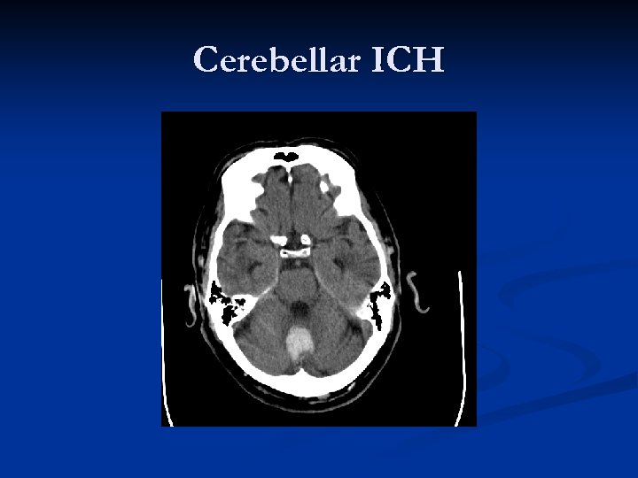 Cerebellar ICH 