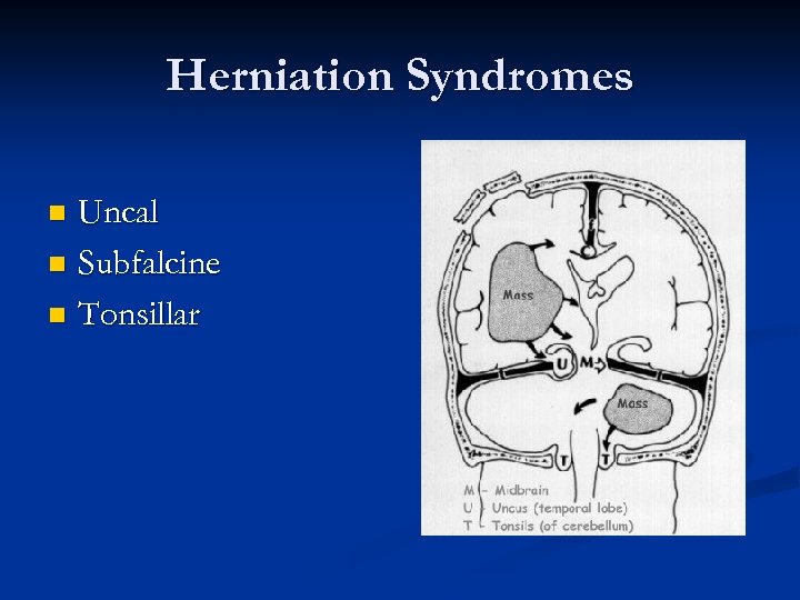 Herniation Syndromes Uncal n Subfalcine n Tonsillar n 