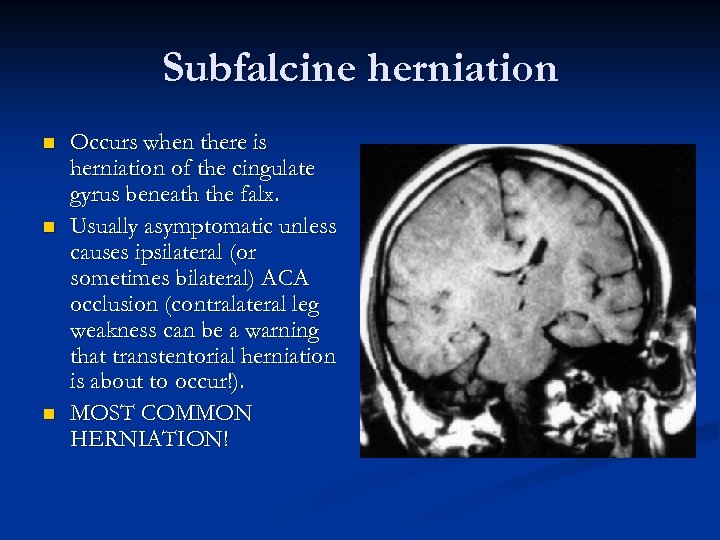 Subfalcine herniation n Occurs when there is herniation of the cingulate gyrus beneath the