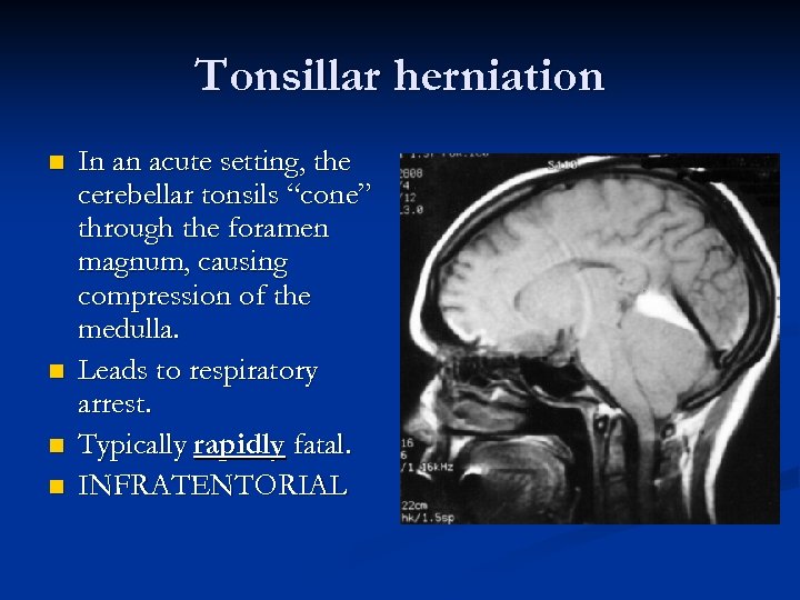 Tonsillar herniation n n In an acute setting, the cerebellar tonsils “cone” through the