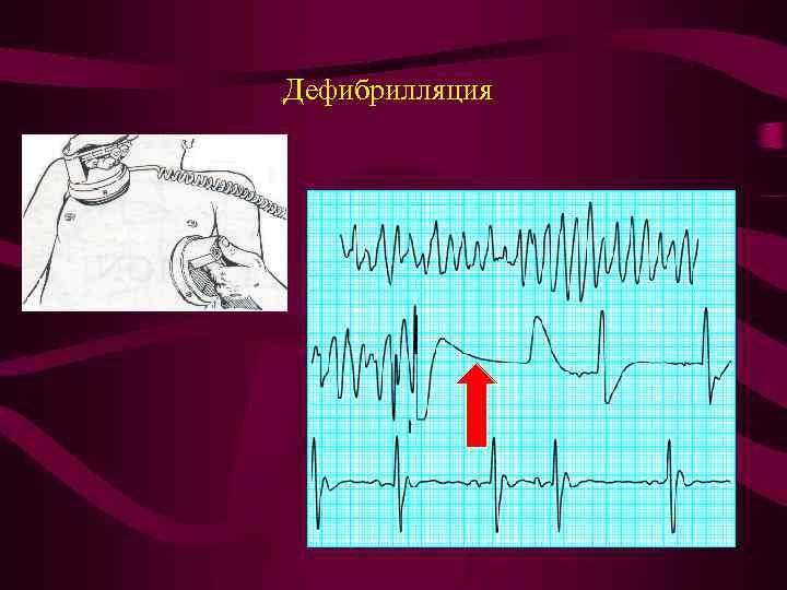  Дефибрилляция 