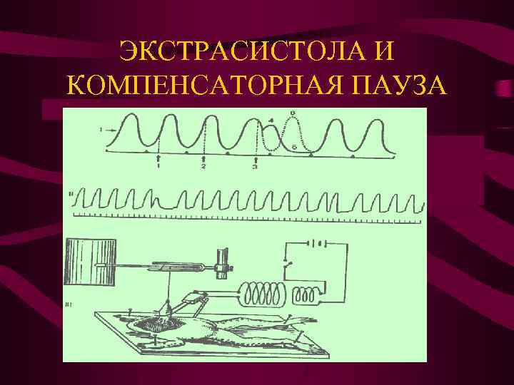 ЭКСТРАСИСТОЛА И КОМПЕНСАТОРНАЯ ПАУЗА 