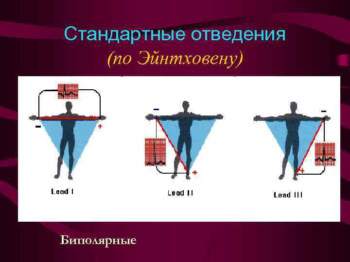 Стандартные отведения (по Эйнтховену) Биполярные 