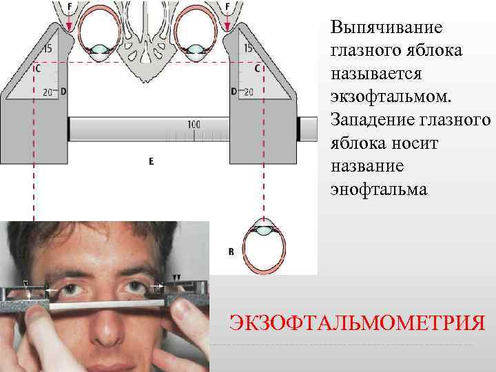 Размер глазного яблока норма. Экзофтальмометрия. Экзофтальмометрия методика. Зеркальный Экзофтальмометр Гертеля. Выступание глазных яблок.