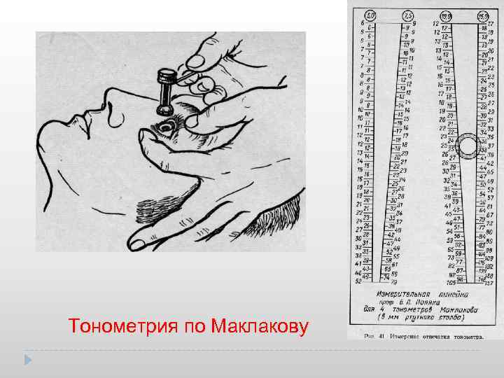 Тонометрия по Маклакову 