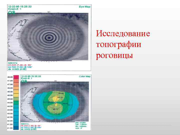 Исследование топографии роговицы 