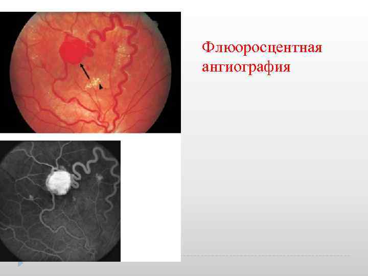 Флюоросцентная ангиография 