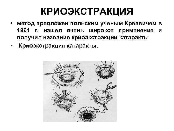 КРИОЭКСТРАКЦИЯ • метод предложен польским ученым Крвавичем в 1961 г. нашел очень широкое применение