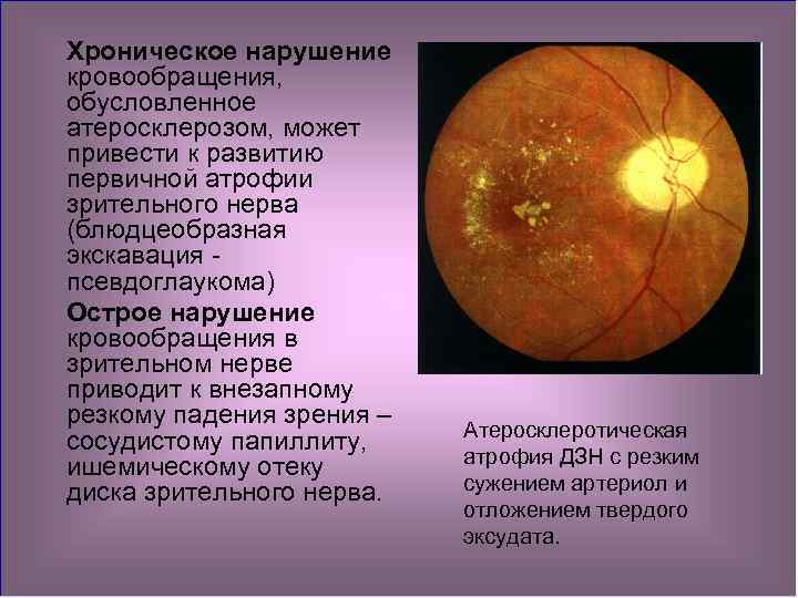 Изменение на глазном дне. Изменения на глазном дне. Глазное дно при атеросклерозе. Исследование глазного дна при атеросклерозе. Изменение органов зрения при атеросклерозе.