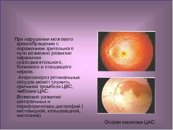 Периферические ретинальные дегенерации. Изменения органа зрения при атеросклерозе. Изменения органа зрения при общих заболеваниях. Нарушение зрения при атеросклерозе. Зрение при нарушении мозгового кровообращения.