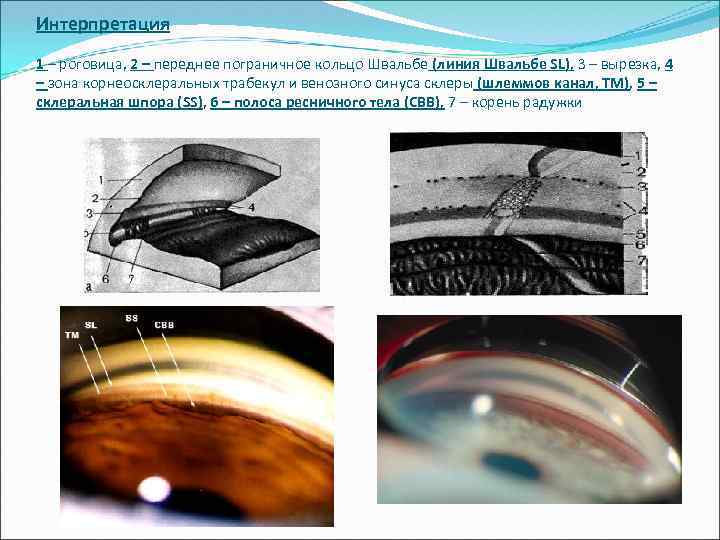 Интерпретация 1 – роговица, 2 – переднее пограничное кольцо Швальбе (линия Швальбе SL), 3