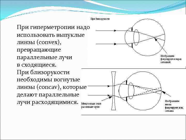 Гиперметропия сл ст